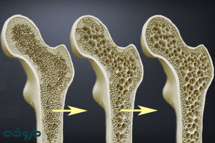 بهترین مکمل درمان پوکی استخوان 