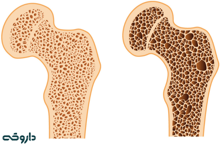 علائم پوکی استخوان