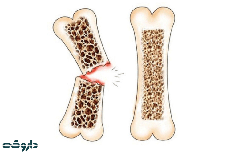 جلوگیری از پوکی استخوان
