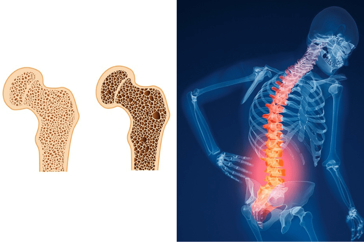 بررسی علائم پوکی استخوان و جلوگیری از آن
